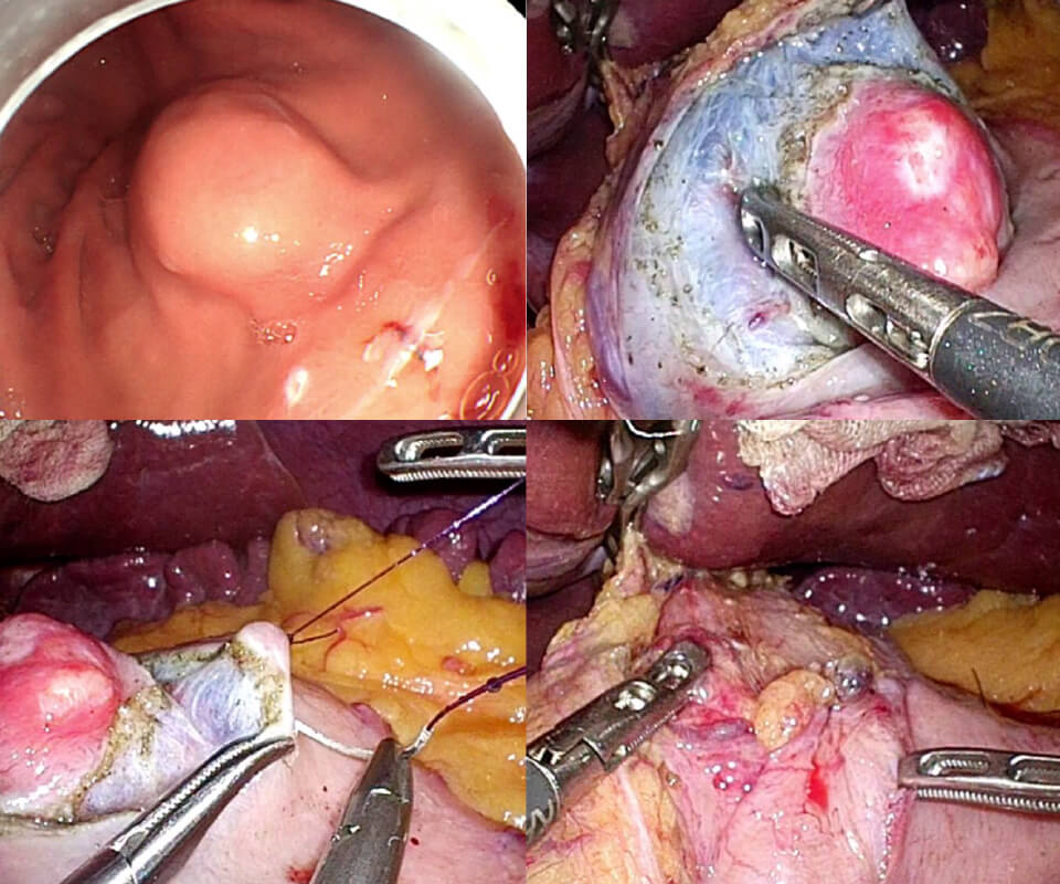 腹腔鏡内視鏡合同手術